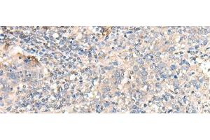 Immunohistochemistry of paraffin-embedded Human cervical cancer tissue using PARS2 Polyclonal Antibody at dilution of 1:30(x200) (PARS2 antibody)