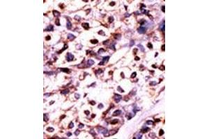 Formalin-fixed and paraffin-embedded human cancer tissue (hepatocarcinoma) reacted with the primary antibody, which was peroxidase-conjugated to the secondary antibody, followed by DAB staining. (UCK2 antibody  (N-Term))
