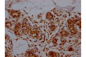 IHC image of ABIN7127462 diluted at 1:100 and staining in paraffin-embedded human breast cancer performed on a Leica BondTM system. (Recombinant E2F1 antibody)