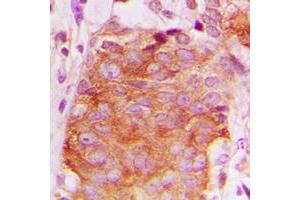 Immunohistochemical analysis of LATH staining in human breast cancer formalin fixed paraffin embedded tissue section. (LATH antibody  (Center))