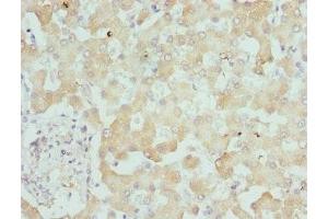 Immunohistochemistry of paraffin-embedded human liver tissue using ABIN7157806 at dilution of 1:100 (DCXR antibody  (AA 1-244))