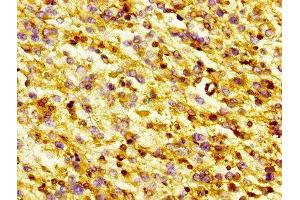 IHC image of ABIN7153749 diluted at 1:300 and staining in paraffin-embedded human glioma performed on a Leica BondTM system. (Gelsolin antibody  (AA 28-782))