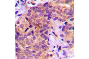 Immunohistochemical analysis of BAD (pS136) staining in human prostate cancer formalin fixed paraffin embedded tissue section. (BAD antibody  (pSer136))