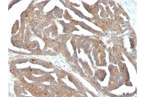Formalin-fixed, paraffin-embedded human ovarian carcinoma stained with GnRH Receptor antibody (F1G4) (GNRHR antibody  (AA 1-29))