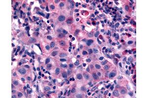 Anti-NANP antibody IHC of human Breast, Carcinoma. (NANP antibody  (N-Term))