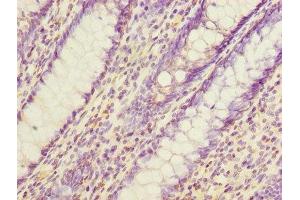 Immunohistochemistry of paraffin-embedded human colon cancer using ABIN7165330 at dilution of 1:100 (EVA1C antibody  (AA 49-322))