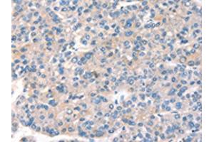 The image on the left is immunohistochemistry of paraffin-embedded Human liver cancer tissue using ABIN7191162(KCNB1 Antibody) at dilution 1/40, on the right is treated with synthetic peptide. (Kv2.1/KCNB1 antibody)