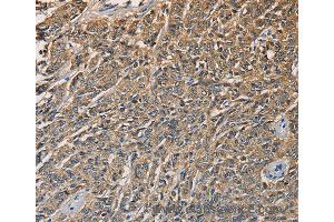 Immunohistochemistry of Human liver cancer using KLK1 Polyclonal Antibody at dilution of 1:40