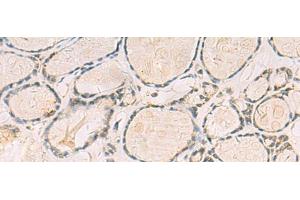 Immunohistochemistry of paraffin-embedded Human thyroid cancer tissue using TCAP Polyclonal Antibody at dilution of 1:55(x200) (TCAP antibody)