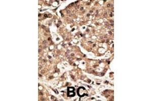 Formalin-fixed and paraffin-embedded human cancer tissue reacted with the primary antibody, which was peroxidase-conjugated to the secondary antibody, followed by AEC staining. (ATG4C antibody  (C-Term))