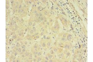 Immunohistochemistry of paraffin-embedded human liver cancer using ABIN7144889 at dilution of 1:100 (ABCB5 antibody  (AA 547-760))