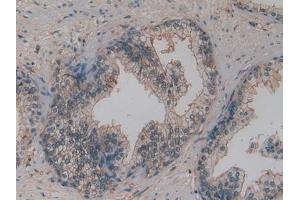 Detection of OPN in Human Prostate cancer Tissue using Polyclonal Antibody to Osteopontin (OPN) (Osteopontin antibody  (AA 17-287))