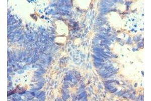 Immunohistochemistry of paraffin-embedded human ovarian cancer using ABIN7162566 at dilution of 1:100 (AMY2A antibody  (AA 242-511))