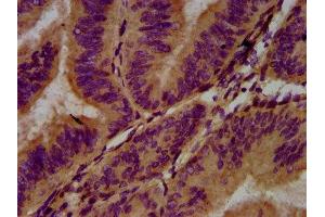 IHC image of ABIN7143399 diluted at 1:400 and staining in paraffin-embedded human endometrial cancer performed on a Leica BondTM system. (Adhesion G Protein-Coupled Receptor G1 (ADGRG1) (AA 26-216) antibody)