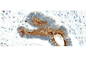 Immunohistochemistry of paraffin-embedded Human colorectal cancer using WWOX Polyclonal Antibody at dilution of 1/20 (WWOX antibody)