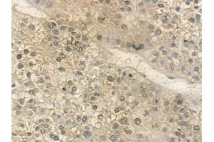 ABIN6261812 and ABIN6268892 at 1/100 staining human hepatocellular carcinoma by IHC-P.
