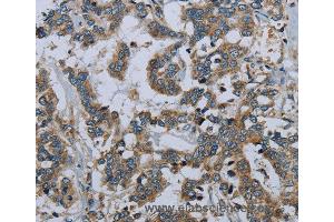 Immunohistochemistry of Human liver cancer using PCK2 Polyclonal Antibody at dilution of 1:60