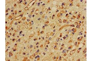 IHC image of ABIN7160401 diluted at 1:400 and staining in paraffin-embedded human glioma performed on a Leica BondTM system. (MBP antibody  (AA 1-197))
