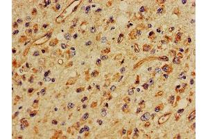 IHC image of ABIN7160401 diluted at 1:400 and staining in paraffin-embedded human glioma performed on a Leica BondTM system.