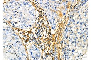 ABIN6265941 and ABIN6272458 at 1/100 staining Human pancreatic cancer by IHC-P. (Vomeronasal 1 Receptor 3 (VMN1R3) (Internal Region) antibody)
