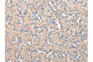 The image on the left is immunohistochemistry of paraffin-embedded Human liver cancer tissue using ABIN7128073(VAPA Antibody) at dilution 1/30, on the right is treated with fusion protein.