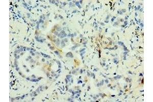 Immunohistochemistry of paraffin-embedded human lung cancer using ABIN7159272 at dilution of 1:100 (MAGEA6 antibody  (AA 75-314))