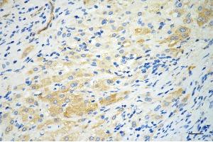 Immunohistochemistry was performed on paraffin-embedded human hepatocarcinoma using MVK antibody (ABIN7799401), 1:200).