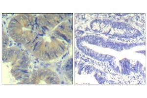 Immunohistochemical analysis of paraffin-embedded human colon carcinoma tissue using chk2 (phospho-Ser33) Antibody (E011527). (CHEK2 antibody  (pSer33))
