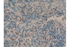 Detection of MUC5AC in Human Esophagus cancer Tissue using Polyclonal Antibody to Mucin 5 Subtype AC (MUC5AC) (MUC5AC antibody)