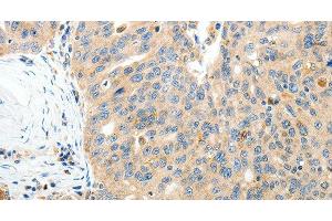 Immunohistochemistry of paraffin-embedded Human ovarian cancer tissue using RAMP3 Polyclonal Antibody at dilution 1:40 (RAMP3 antibody)