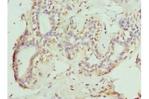 Immunohistochemistry of paraffin-embedded human breast cancer using ABIN7161014 at dilution of 1:100 (NOX5 antibody  (AA 661-765))