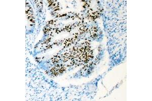 Immunohistochemical analysis of HCFC1 staining in human colon cancer formalin fixed paraffin embedded tissue section. (HCFC1 antibody  (N-Term))