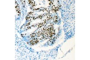 Immunohistochemical analysis of HCFC1 staining in human colon cancer formalin fixed paraffin embedded tissue section.