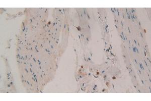 Detection of TIMP1 in Human Stomach cancer Tissue using Polyclonal Antibody to Tissue Inhibitors Of Metalloproteinase 1 (TIMP1) (TIMP1 antibody  (AA 25-207))