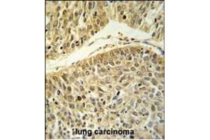 RERE Antibody (N-term) (ABIN653912 and ABIN2843149) IHC analysis in formalin fixed and paraffin embedded lung carcinoma followed by peroxidase conjugation of the secondary antibody and DAB staining. (RERE antibody  (N-Term))