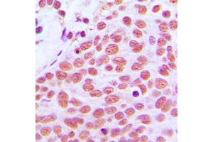 Immunohistochemical analysis of c-Jun staining in human breast cancer formalin fixed paraffin embedded tissue section.