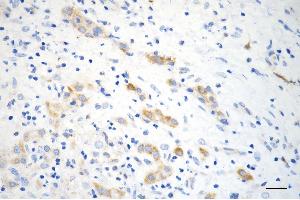 Immunohistochemistry was performed on paraffin-embedded human hepatocarcinoma using ACSL4 antibody (ABIN7797498), 1:200).