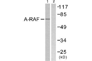 Immunohistochemistry analysis of paraffin-embedded human breast carcinoma tissue using A-RAF (Ab-301/302) antibody. (ARAF antibody  (Tyr301, Tyr302))