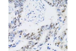 Immunohistochemistry of paraffin-embedded Human colon carcinoma using CDK6 Polyclonal Antibody at dilution of 1:100 (40x lens).