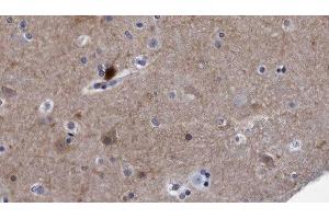 ABIN6278497 at 1/100 staining Human brain cancer tissue by IHC-P. (Reticulon 4 antibody  (Internal Region))