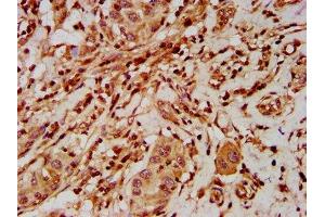 IHC image of ABIN7151576 diluted at 1:500 and staining in paraffin-embedded human liver cancer performed on a Leica BondTM system.