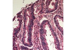 Immunohistochemical analysis of Apolipoprotein L3 staining in human colon cancer formalin fixed paraffin embedded tissue section. (APOL3 antibody  (Center))