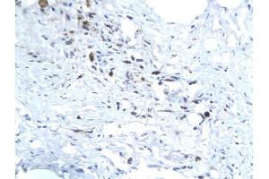 Formalin-fixed and paraffin embedded human liver labeled with Anti-Hepatitis E Virus ORF3 Polyclonal Antibody, Unconjugated (ABIN726350) followed by conjugation to the secondary antibody and DAB staining