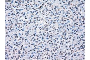 Immunohistochemical staining of paraffin-embedded liver tissue using anti-CHEK2mouse monoclonal antibody. (CHEK2 antibody)
