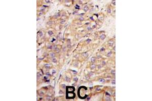 Formalin-fixed and paraffin-embedded human breast carcinoma tissue reacted with SMURF1 polyclonal antibody  , which was peroxidase-conjugated to the secondary antibody, followed by DAB staining. (SMURF1 antibody  (N-Term))
