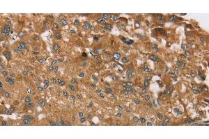 Immunohistochemistry of paraffin-embedded Human liver cancer tissue using RPS6KA2 Polyclonal Antibody at dilution 1:40 (RPS6KA2 antibody)