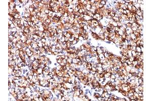 Formalin-fixed, paraffin-embedded human Renal Cell Carcinoma stained with CAIX Mouse Monoclonal Antibody (CA9/781). (CA9 antibody)