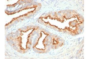 Formalin-fixed, paraffin-embedded human Prostate Carcinoma stained with CD10 Mouse Monoclonal Antibody (MME/2579). (MME antibody  (AA 583-740))