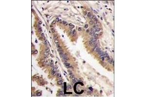 Formalin-fixed and paraffin-embedded human lung carcinoma tissue reacted with ERK4 antibody (C-term), which was peroxidase-conjugated to the secondary antibody, followed by DAB staining. (MAPK7 antibody  (C-Term))