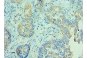 Immunohistochemistry of paraffin-embedded human lung cancer using ABIN7158946 at dilution of 1:100 (MDH2 antibody  (AA 59-338))